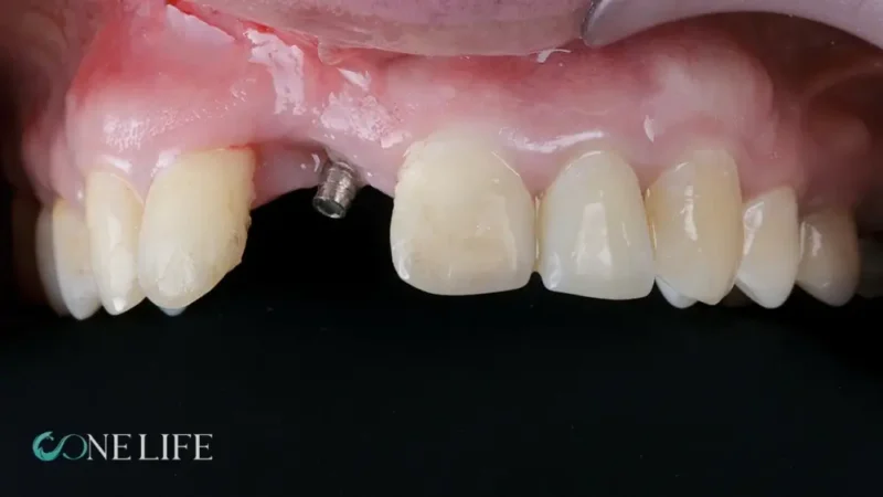 Picture showing how a failed dental implant looks like