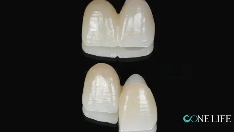 Close-up of a zirconia cantilever bridge (two-crown prosthesis)