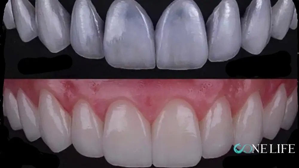 Emax ivoclar porcelain veneers in Turkey
