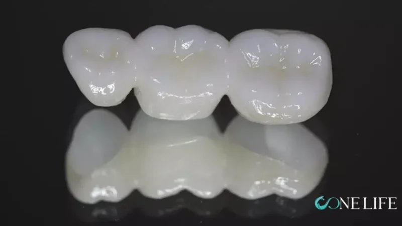 Close-up of a fixed zirconia bridge (three-crown prosthesis)