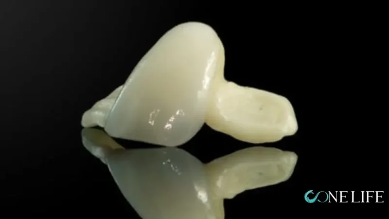 Close-up of a zirconia maryland bridge