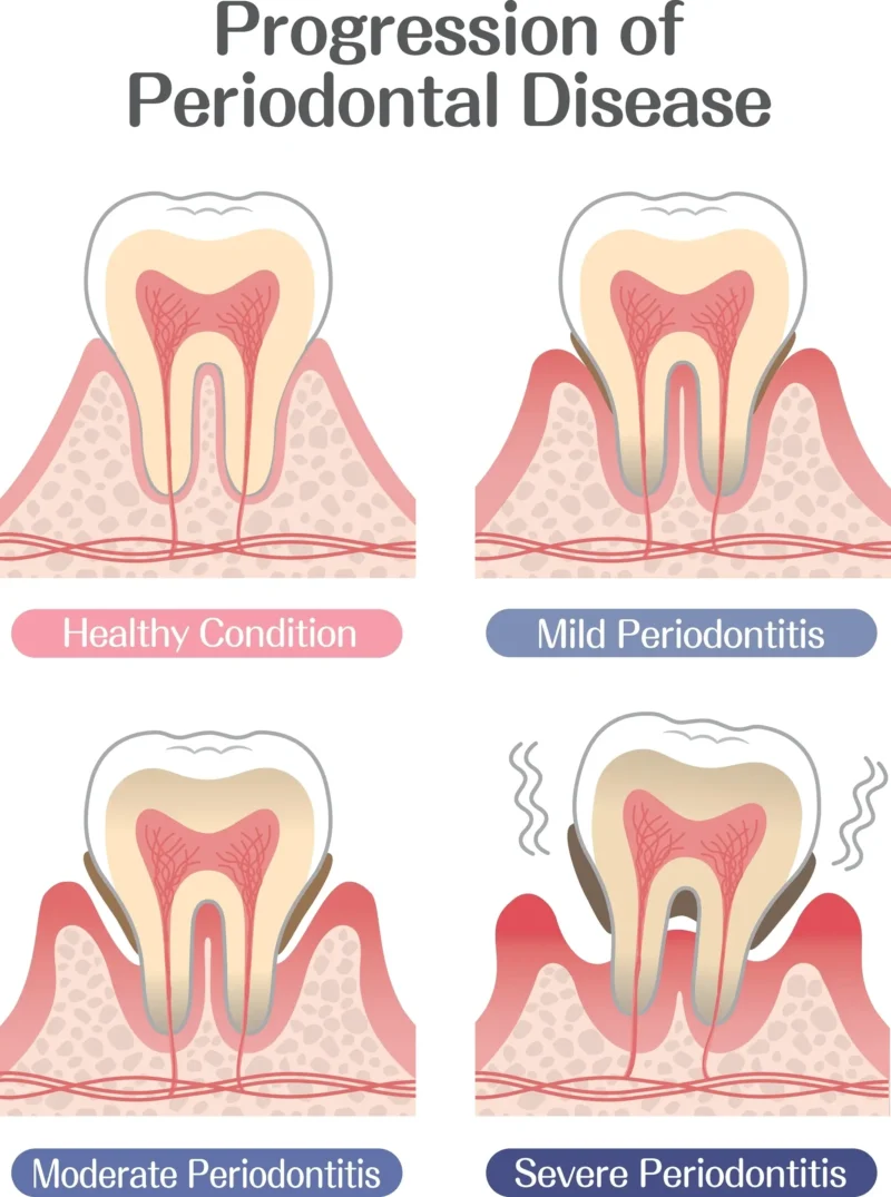Infographic image showing the 4 stages of gum disease