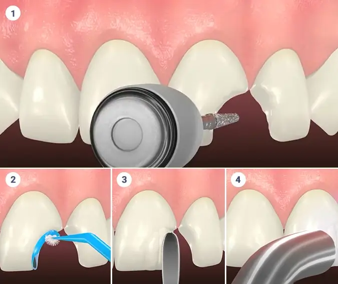 Infographic image showing the composite bonding procedure in 4 steps in a cartoon medical textbook like sequence.