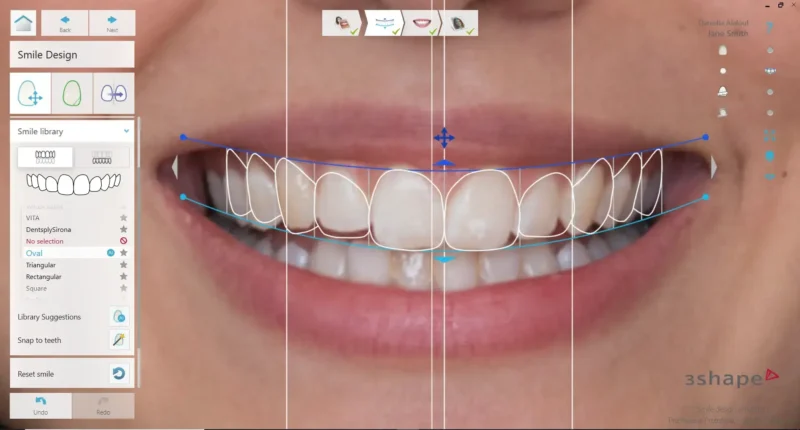Close-up of 3Shape digital smile design software, in the process of planning a dental makeover.