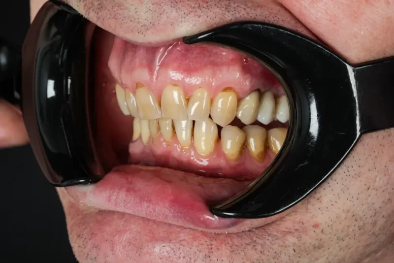 Close-up image of a patient's mouth with clear gum recession, during a diagnosis for gum grafting.