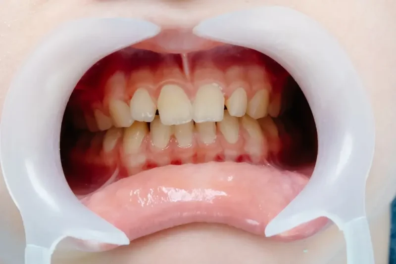 Close-up picture of a patient mouth with gingigivits