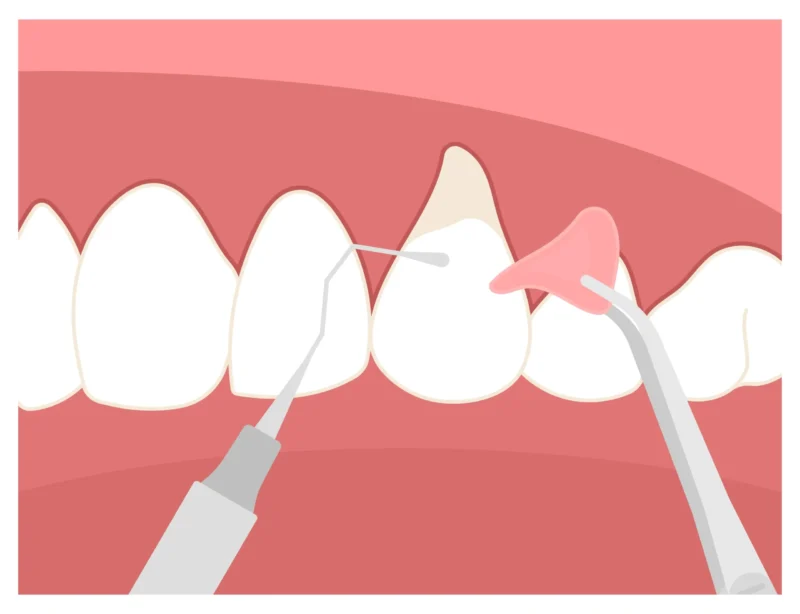Cartoon image illustrating what a gingival graft is