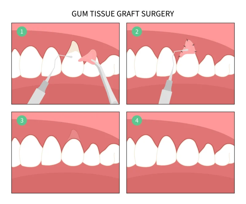Step by step illustration of how gum grafting surgery unfolds from start to final results post-healing.