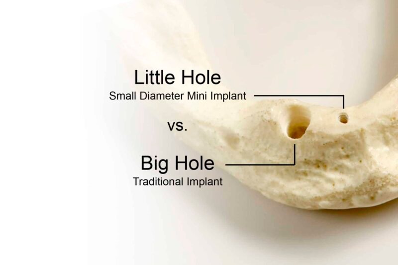 Picture comparing the drill size on the jawbone of a mini dental implant vs regular implant