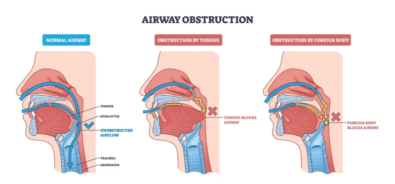 Medical-grade illustration of the parts of the mouth showing the 3-step process through which choking or obstruction can happen.