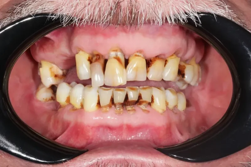 Close-up picture of a patient mouth with periodontitis at a 3-4 stage