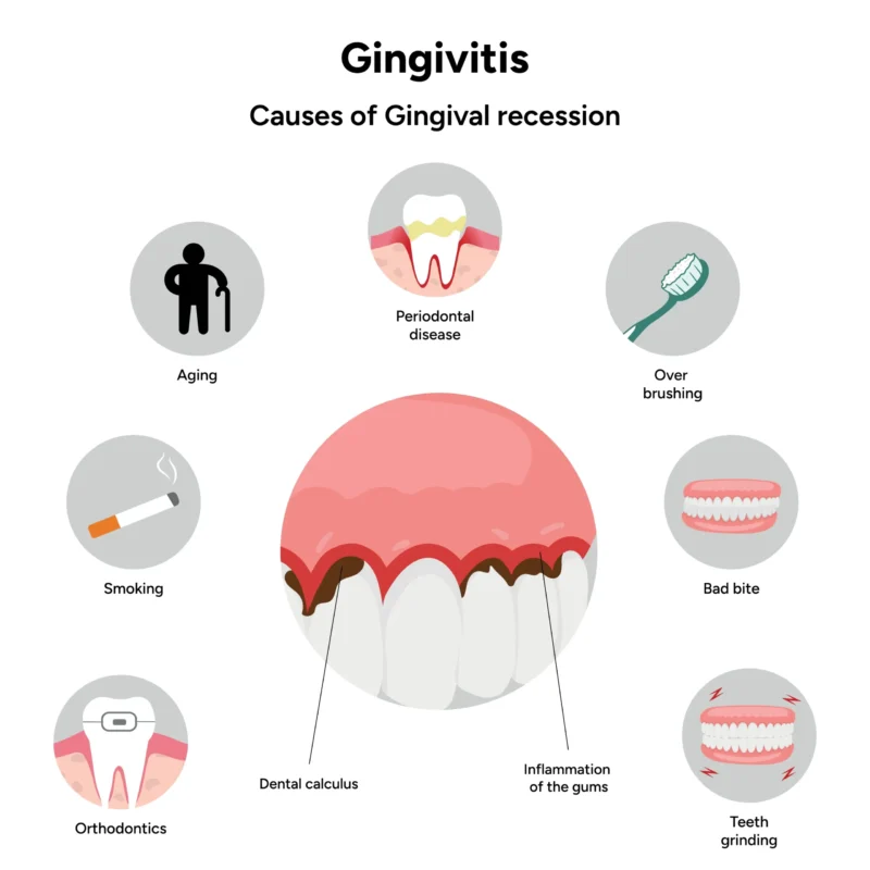 Infographic image illustrating the causes of gingival regression