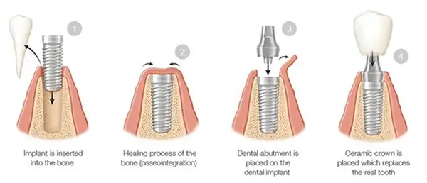 Infographic image illustrating the dental abutment process in 4 steps