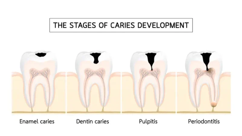 Medical illustration of the 4 stages of caries development