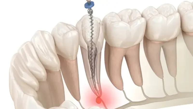 Medical illustration of root canal treatment