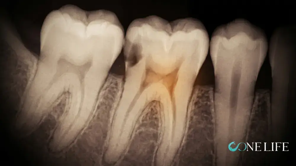 Panoramic x-ray in sepia showing a close-up of two teeth illustrating teeth filling vs root canal treatment difference as it must be applied according to the caries case