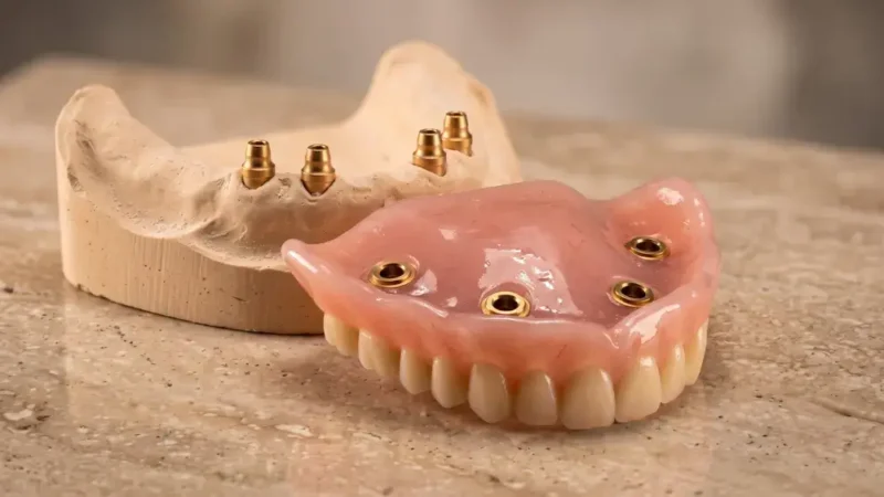 Implantatgetragene Overdenture: herausnehmbarer Zahnersatz mit Kugelattachments und Gipsmodell mit vier Implantaten