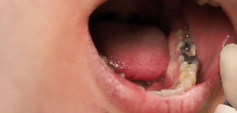 Intraoral photo showing a sequence of human teeth affected by advanced tooth decay and significant gingival inflammation. Multiple cavities are visible as dark areas on the molars and premolars, and the gums are visibly red and swollen.
