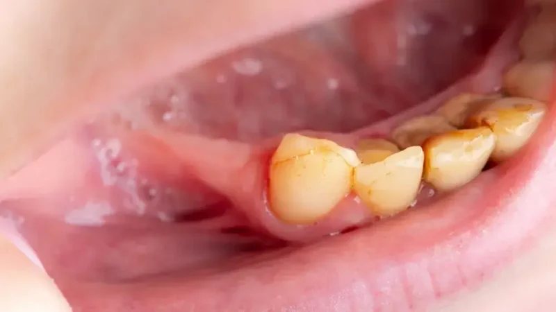 Late-stage gingivitis shown in a close-up of lower back teeth with swollen gums and heavy tartar and staining along the gumline