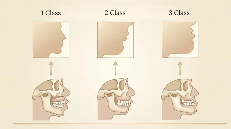 Medical illustration showing three different types of malocclusion in a child's jaw profile, including a normal bite, overbite, and underbite.