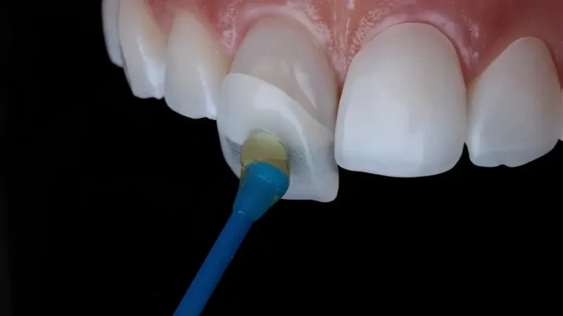 No-prep veneers application: dentist applying bonding agent to a front tooth with a blue microbrush.