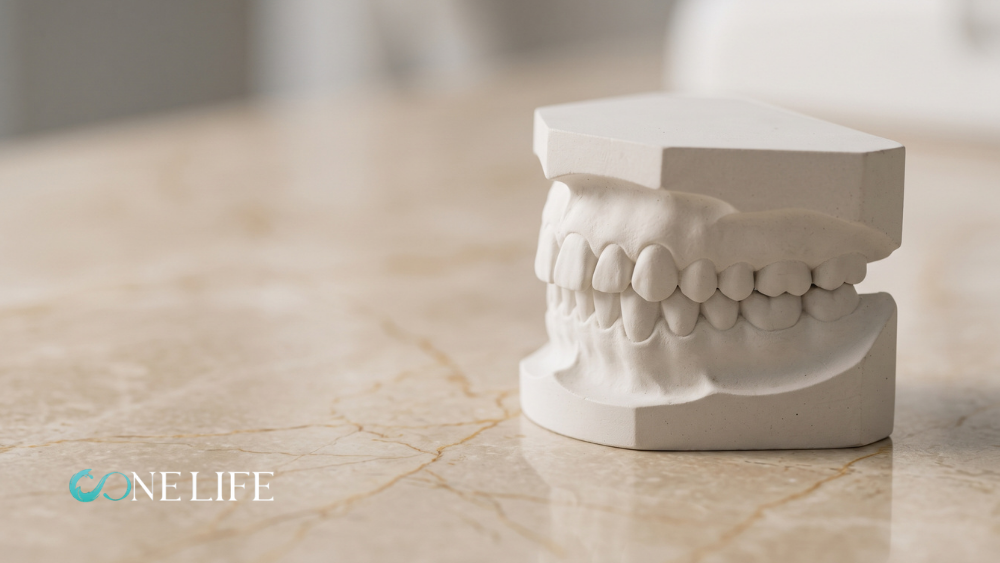 Close-up of a plaster dental cast illustrating an overbite condition in a high-end clinical setting with a marble table.