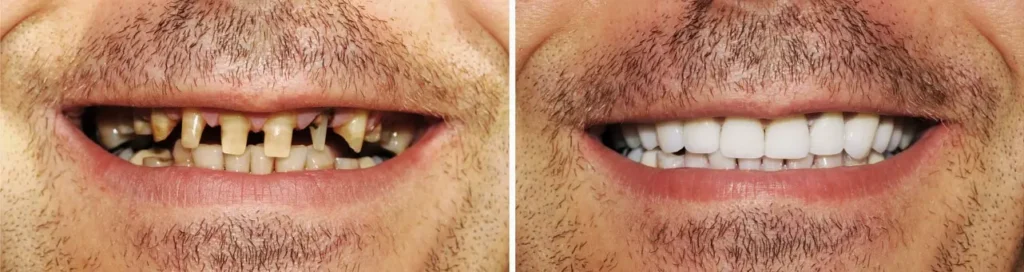 Teeth shaving before and after: male patient's worn, discolored front teeth on the left and restored white teeth on the right.