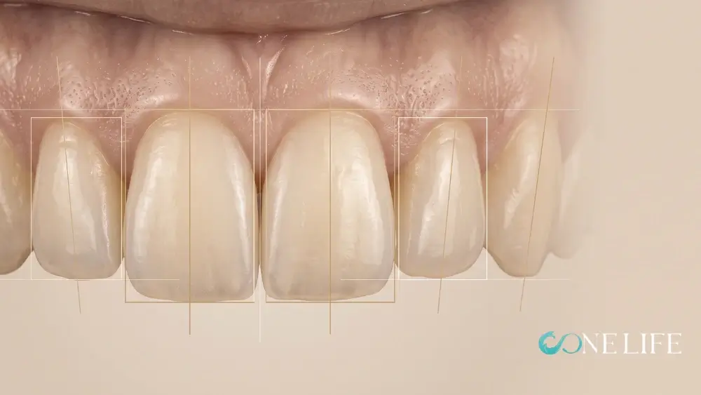 Teeth shaving planning: close-up of upper front teeth with digital guide lines marking tooth proportions and shape.