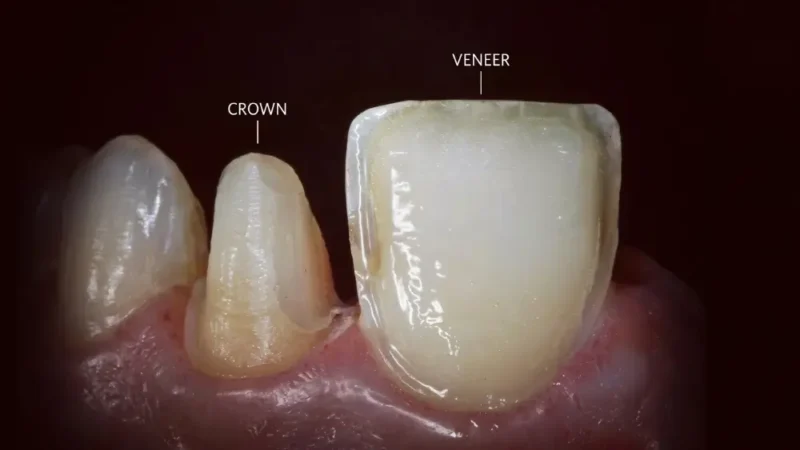 Teeth shaving for veneers vs crowns: labeled comparison of a tooth prepared for a crown beside one restored with a veneer.