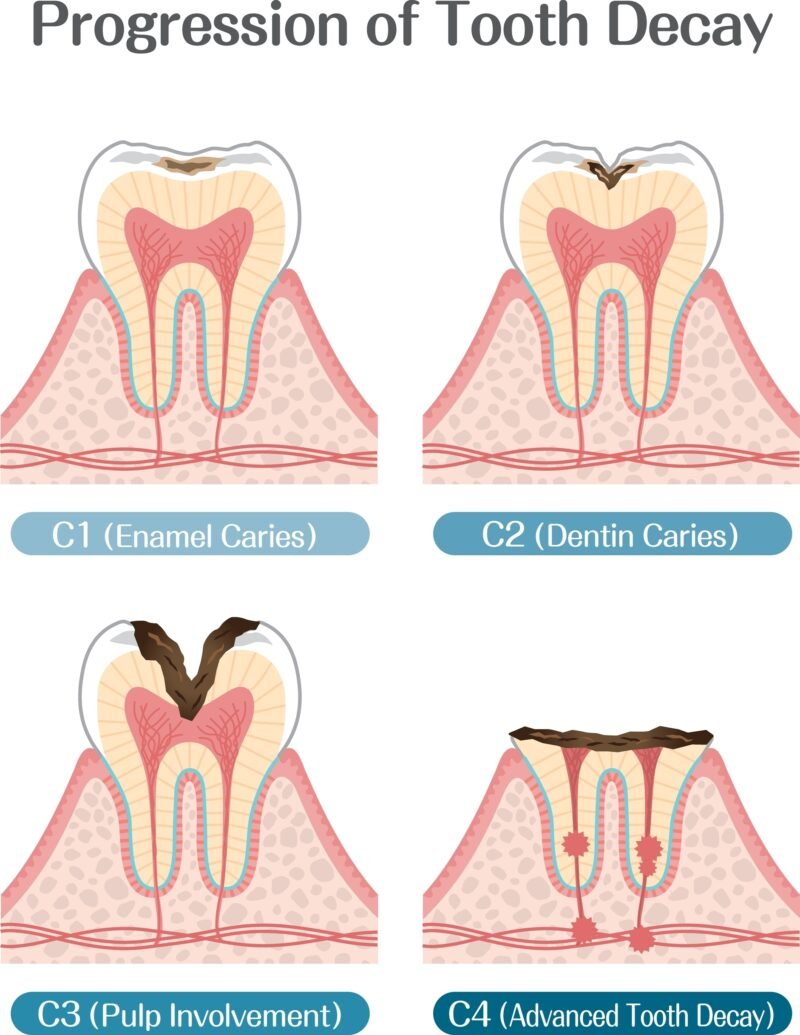 Medical illustration titled "Progression of Tooth Decay" showing the four tooth decay stages: enamel caries (C1), dentin caries (C2), pulp involvement (C3), and advanced tooth decay (C4).
