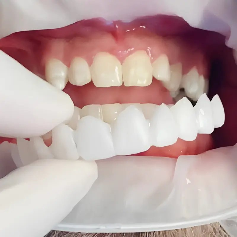 A close-up view of a dental professional's gloved hands holding a set of bright white snap-on veneers and holding them up to a patient's natural, upper teeth in a before-and-after style comparison.