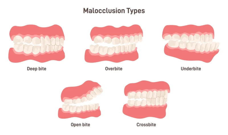 Alt text: Diagram showing five types of malocclusion: deep bite, overbite, underbite, open bite and crossbite