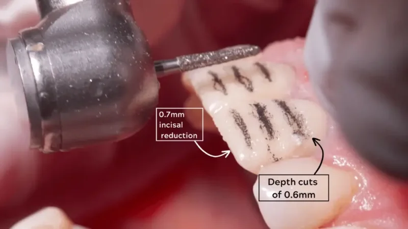 Veneer filing prep: dental bur cutting 0.6mm depth grooves into a front tooth alongside a 0.7mm incisal reduction.